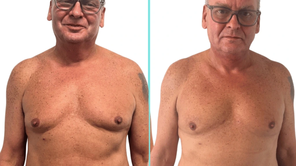 Gynecomastia transformation with Gentle Sculpt